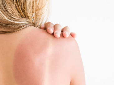 What Are The Best Ways To Treat Sunburn Naturally?